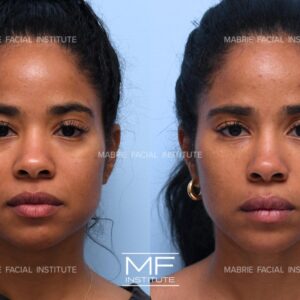 dermal fillers before and after face