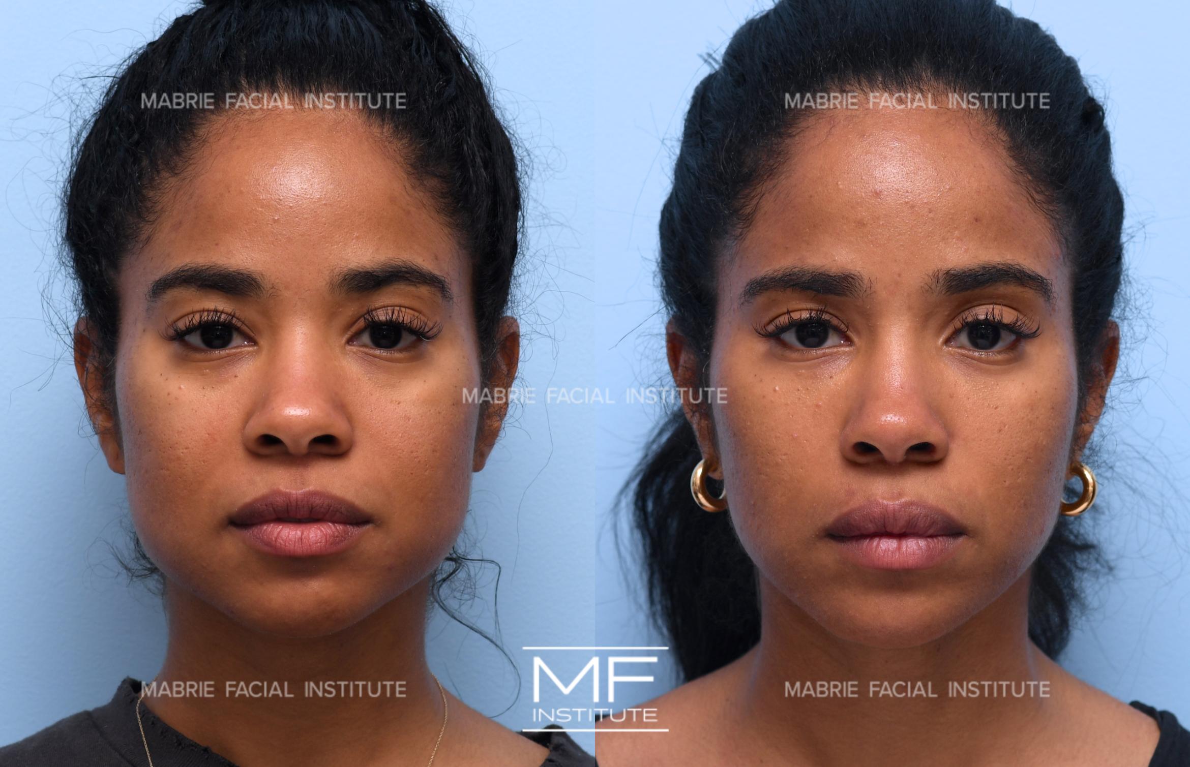 dermal fillers before and after face