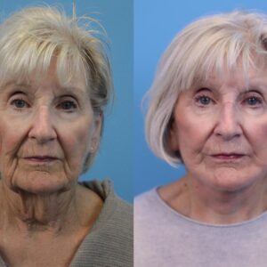 mini face lift cost 1