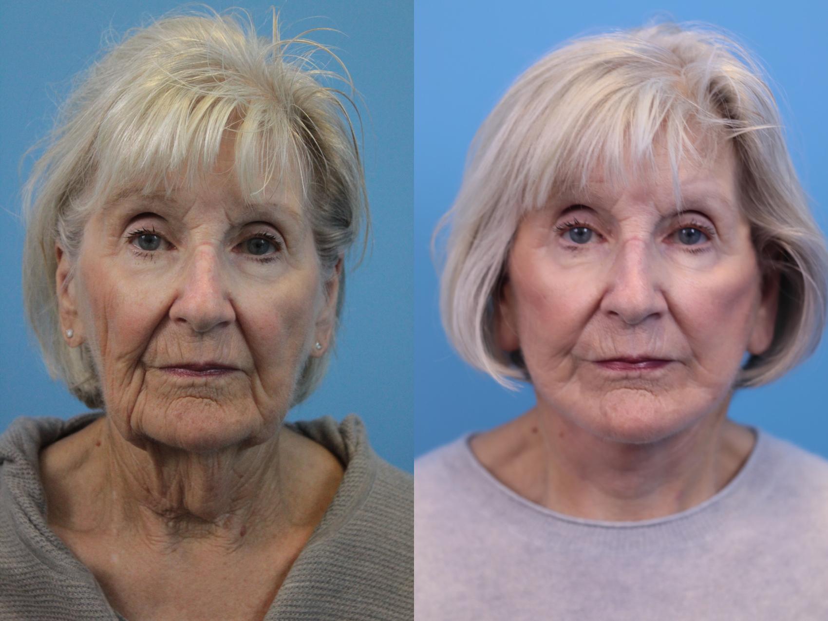mini face lift cost 1