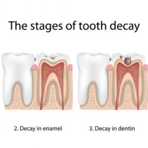 Stainless Steel Dental Crowns Are Taking Dentistry By Storm—Here’S The Breakthrough You Didn’T See Coming!