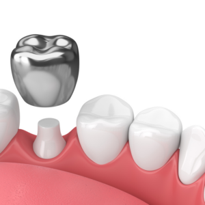 Stainless Steel Crowns Are Revolutionizing Dentistry—Watch Patients Stun At This Game-Changer!