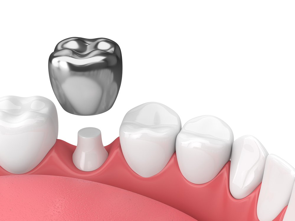 Stainless Steel Crowns Are Revolutionizing Dentistry—Watch Patients Stun At This Game-Changer!