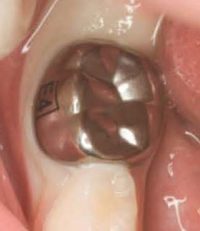 No More Gaps, No More Pastes—Stainless Steel Crowns Are Taking Dental Revamps To A Whole New Level!