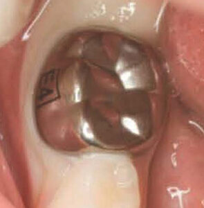 Revolutionizing Smile Makeovers: How Stainless Steel Crowns Are Redefining Dental Beauty!